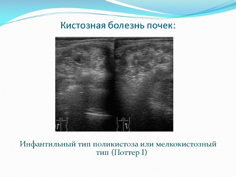 Кистозная болезнь почек:           Инфантильный